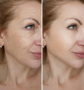 anti-aging-before-and-after-min-279x300